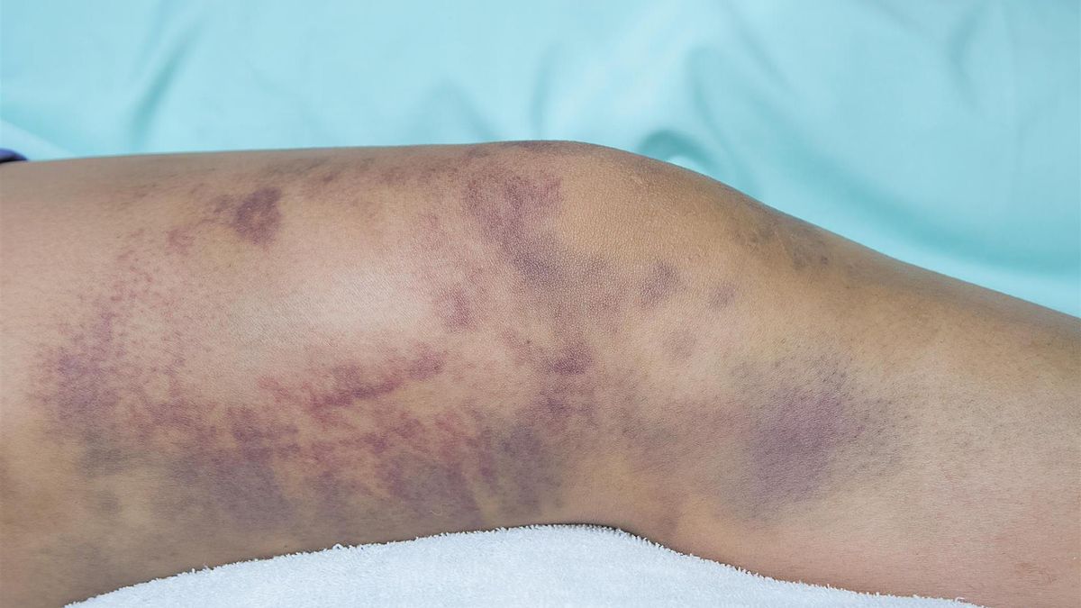 Siniaki mogą być symptomem poważnej choroby