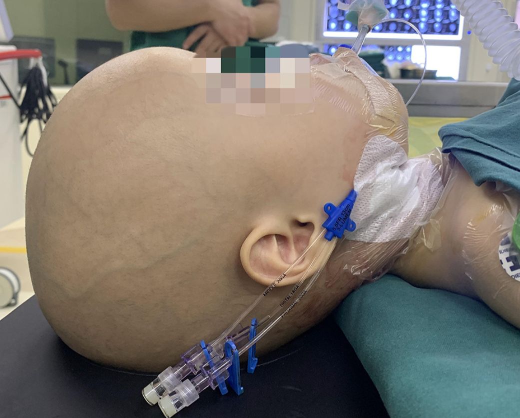 Głowa dziecka była znacznie powiększona