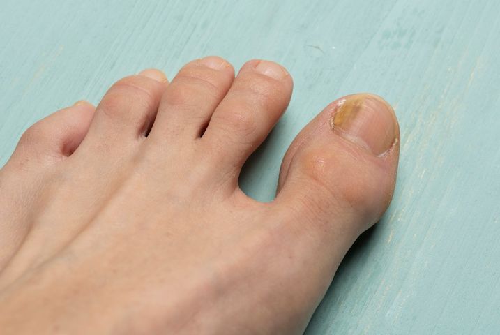 Grzybica to zakaźna choroba, która może objąć tak skórę, jak i paznokcie.