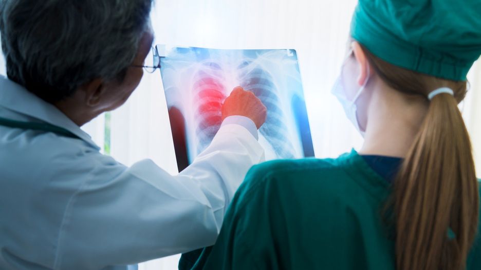 Liczba zachorowań na raka płuc w Polsce nie spada