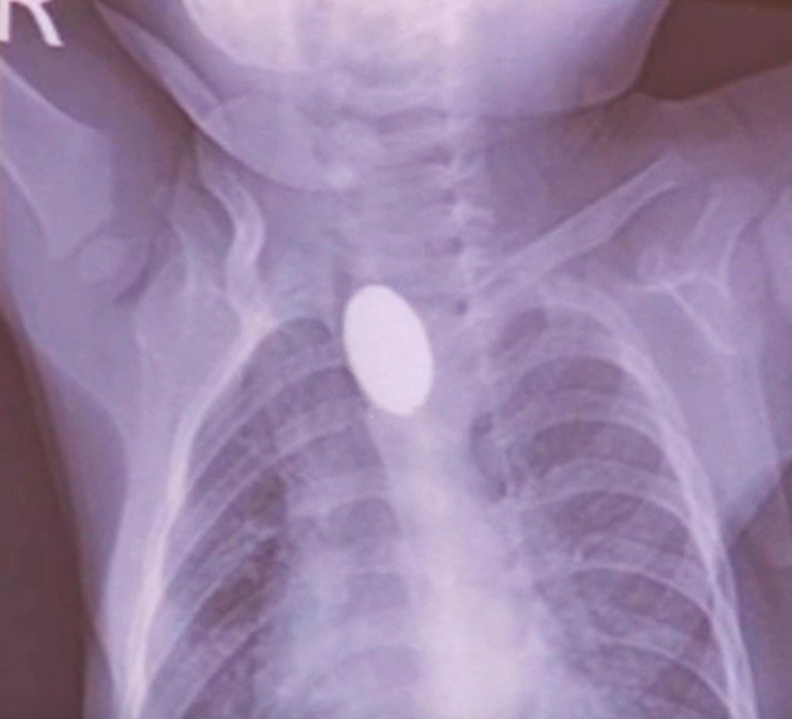 Chłopiec połknął baterię