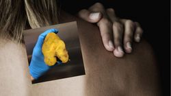 Lekarz ostrzega. Tłuszczak to najczęstszy nowotwór tkanek miękkich