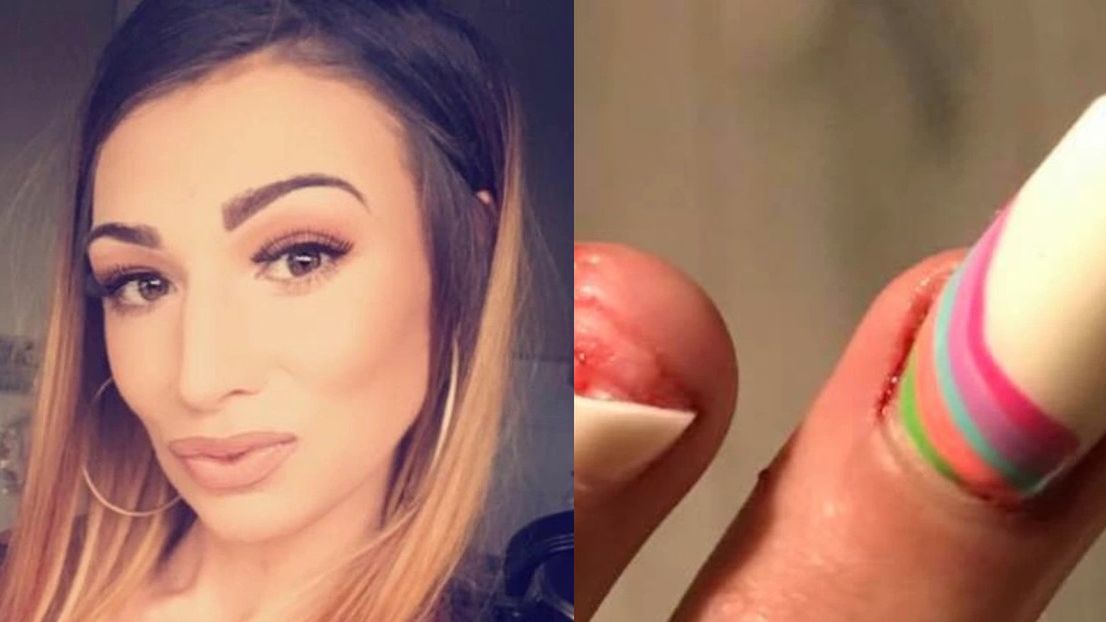 Rachelann Gibson i jej zerwany paznokieć