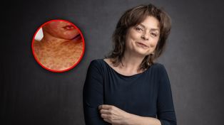 Odra nie kończy się na wysypce. "Ten wirus potrafi skasować odporność"
