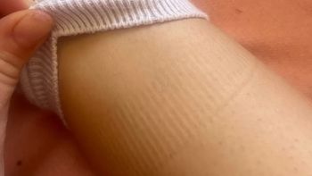 Widzisz takie ślady na nogach? To sygnał alarmowy