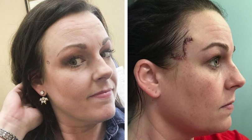 Myślała, że to pryszcz. Zmiana na skórze okazała się o wiele bardziej groźna