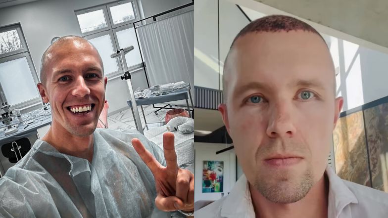 Dawid Piątkowski relacjonuje przeszczep włosów