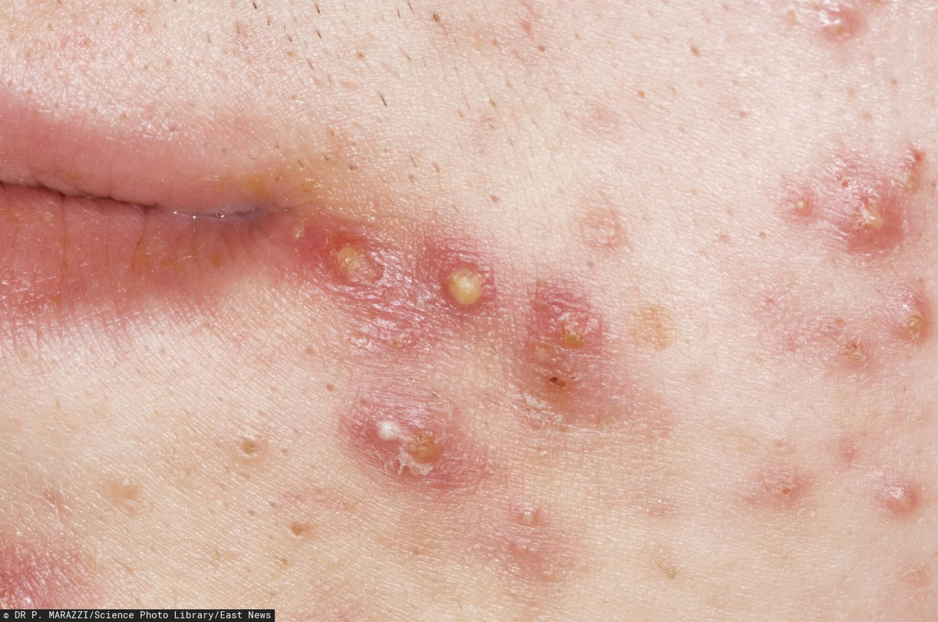 Alkohol sprzyja rozwojowi stanów zapalnych