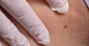 Przełom w leczeniu czerniaka. Dają szansę na pełne wyleczenie