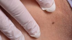 Przełom w leczeniu czerniaka. Dają szansę na pełne wyleczenie