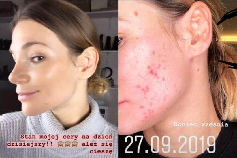 Maja Bohosiewicz pokazała trądzik