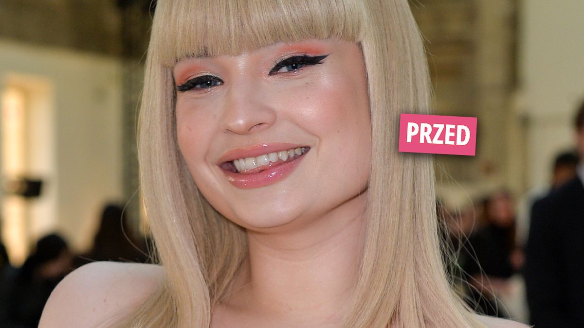 29-letnia Kim Petras oszpeciła się serią zabiegów upiększających. Zdjęcia twarzy piosenkarki przeraziły fanów