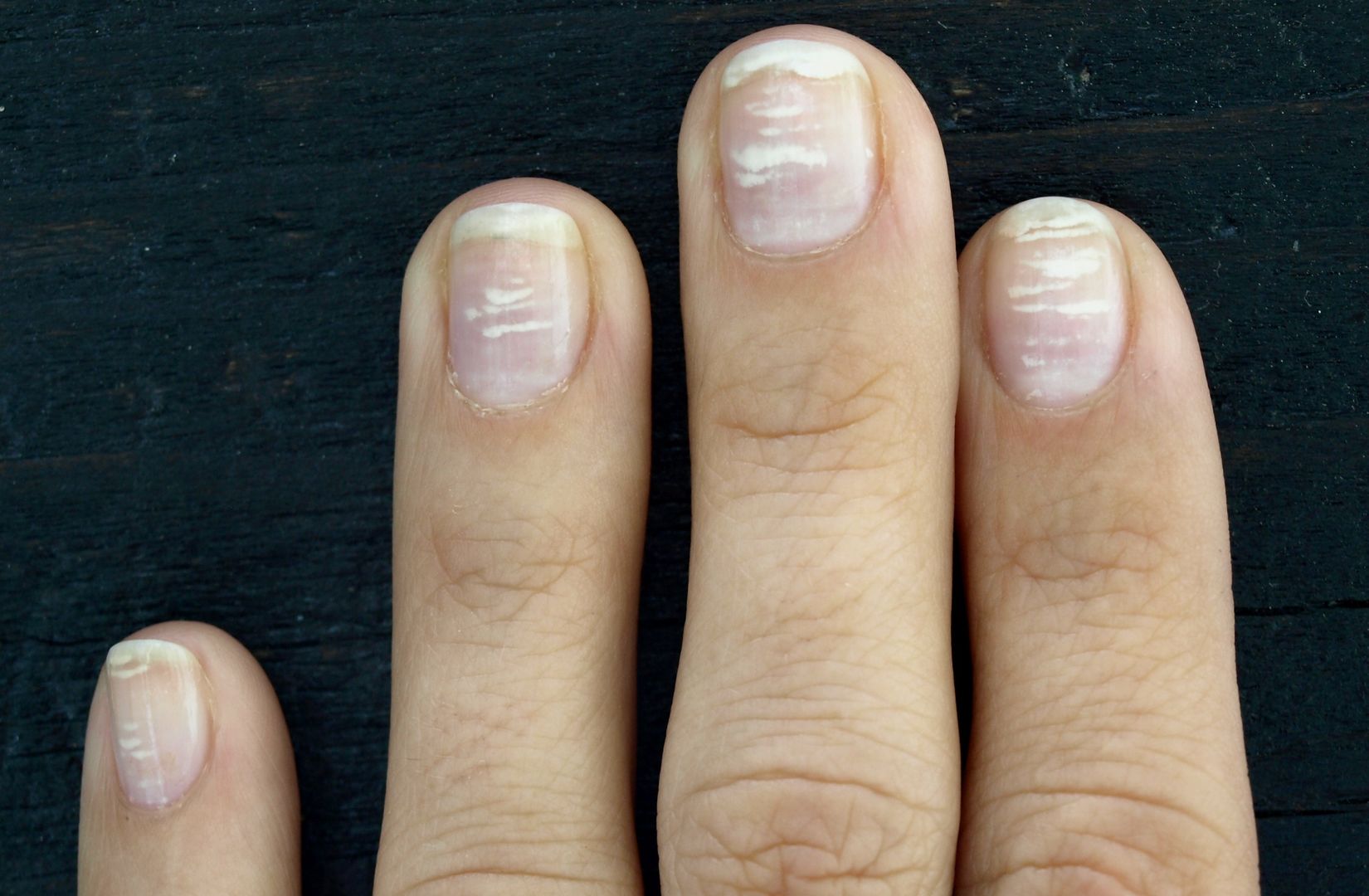Zauważyłeś białe plamki na paznokciach? Mogą zwiastować problemy zdrowotne
