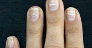 Zauważyłeś białe plamki na paznokciach? Mogą zwiastować problemy zdrowotne