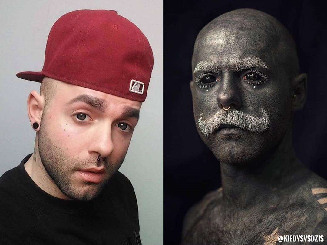 Adam Curlykale przed usunięciem jąder, moszny i penisa