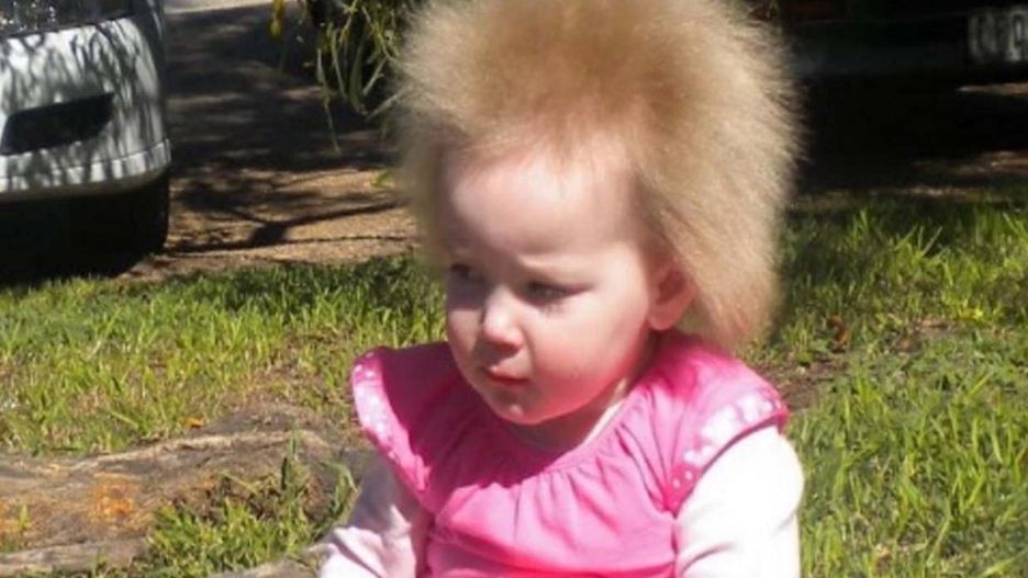 Z choroby uczyniła atut. Dziewczynka z włosami jak Einstein ma już 13 lat