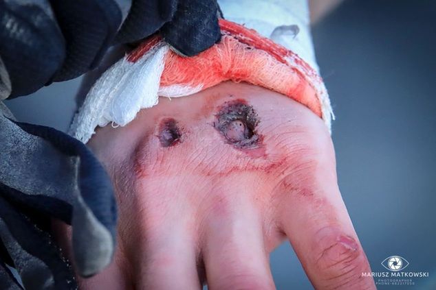 Tak wyglądała dłoń Oskara Polisa chwilę po upadku / Oskar Polis Racing