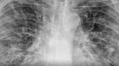Zmiany w płucach po COVID-19. Dramatyczne zdjęcia RTG