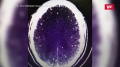 46-latek z tasiemcami w mózgu. Lekarze ostrzegają