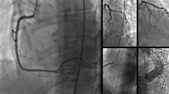 Przyczyny i objawy tętniaka serca 