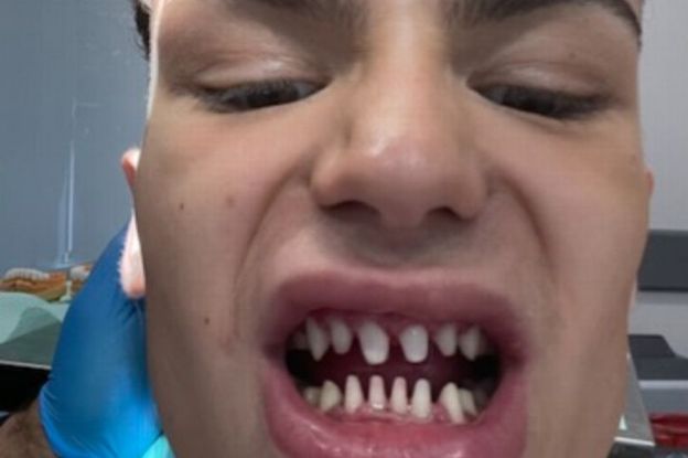 Aspirujący model zrobił sobie zęby w Turcji. Teraz żałuje. "Wyglądam jak rekin" (FOTO)