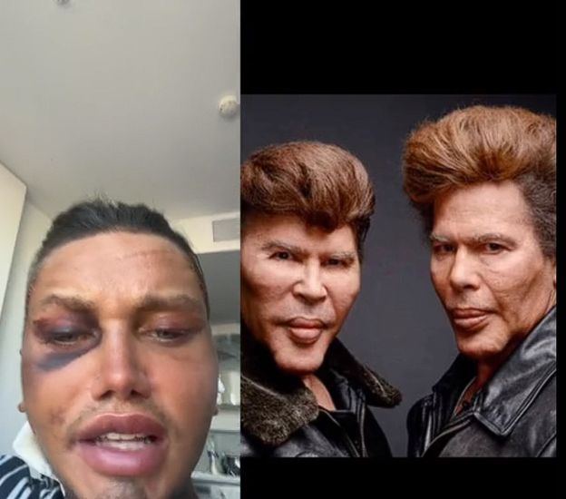 25-latek ma za sobą 15 OPERACJI PLASTYCZNYCH. Pokazał swoją twarz po kolejnym zabiegu