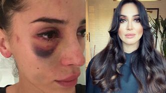 TYLKO NA PUDELKU: Była partnerka piłkarza pokazuje twarz ZMASAKROWANĄ po pobiciu: "Groziła mi UTRATA WZROKU"