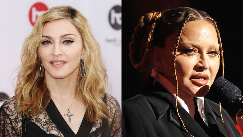 Lekarz wylicza, jakim zabiegom poddała się Madonna. Lista jest długa... "Zmiana kształtu twarzy jest DRASTYCZNA" (ZDJĘCIA)