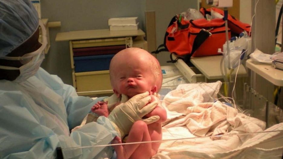 Zdiagnozowano u niego wodogłowie