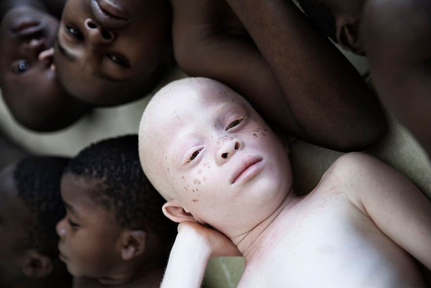 Wyjątkowe zdjęcia albinosów pomagają zwrócić uwagę na ich trudną sytuację w Tanzanii