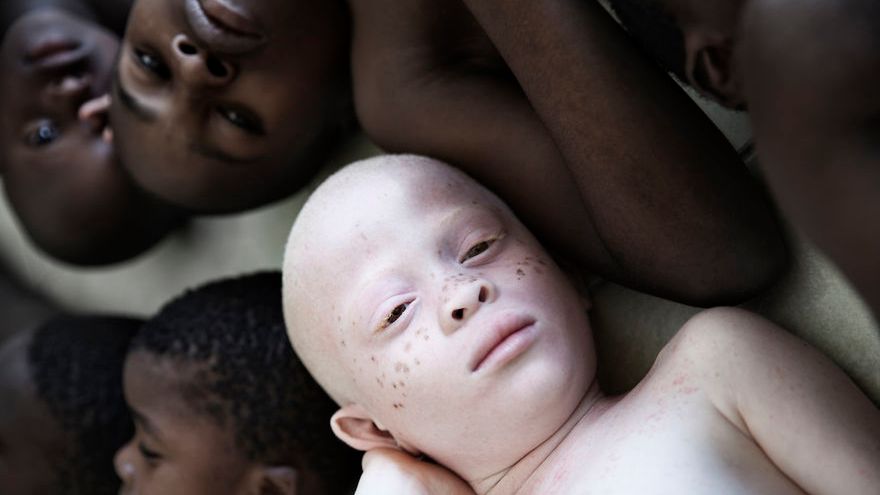 Wyjątkowe zdjęcia albinosów pomagają zwrócić uwagę na ich trudną sytuację w Tanzanii 1