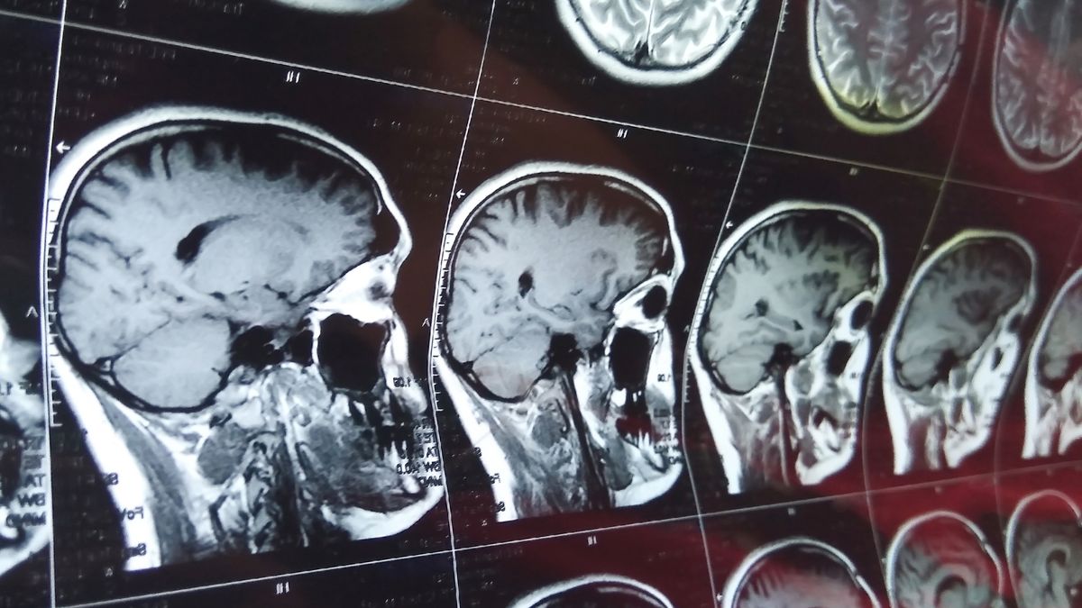 Nowe spojrzenie na neuroplastyczność mózgu