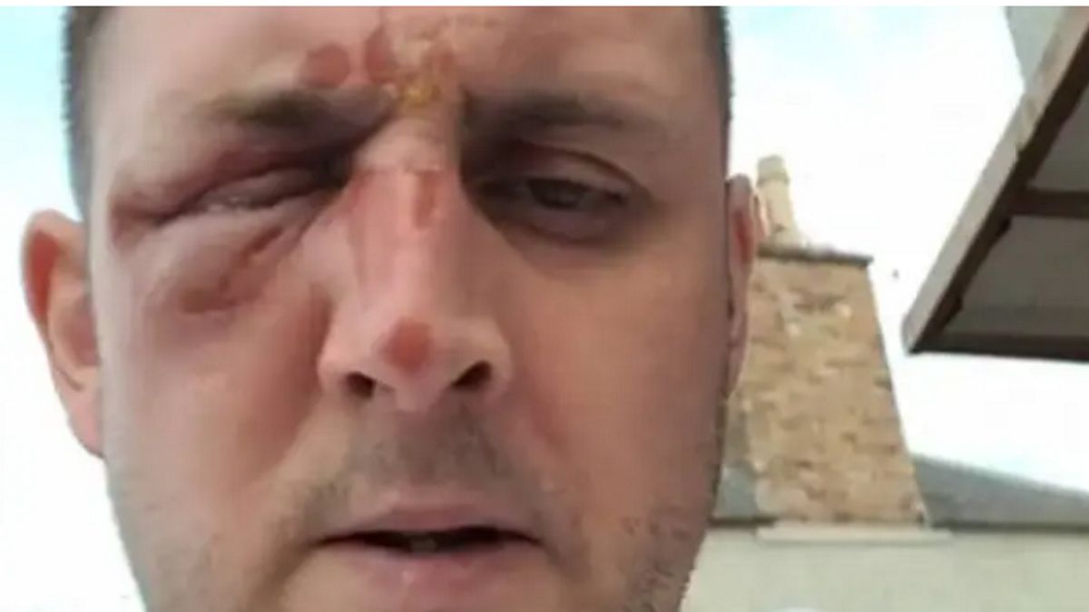 Australijczyk doznał poparzeń nawet na twarzy