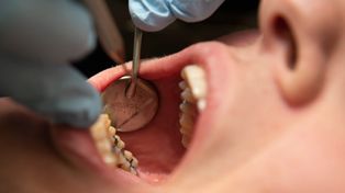 Turystyka dentystyczna Polaków. Tu jeżdżą po plomby za 50 zł