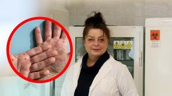 Wirus mpox już w Europie. Urodzeni przed tym rokiem mogą mieć ochronę