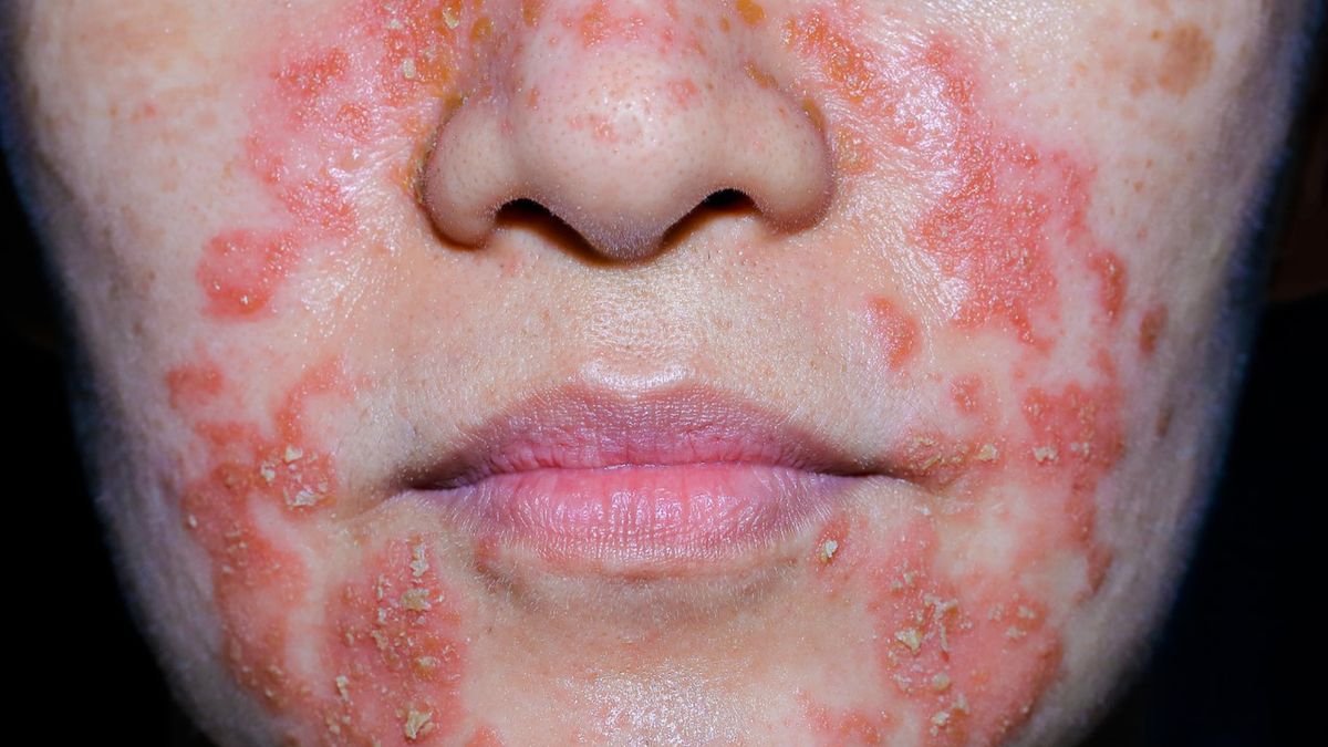Łojotokowe zapalenie skóry twarzy może powodować duży dyskomfort u pacjentów.
