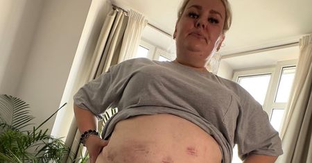 Kinga Zawodnik przeszła operację zmniejszenia żołądka. "Koszmar". Pokazała zdjęcia