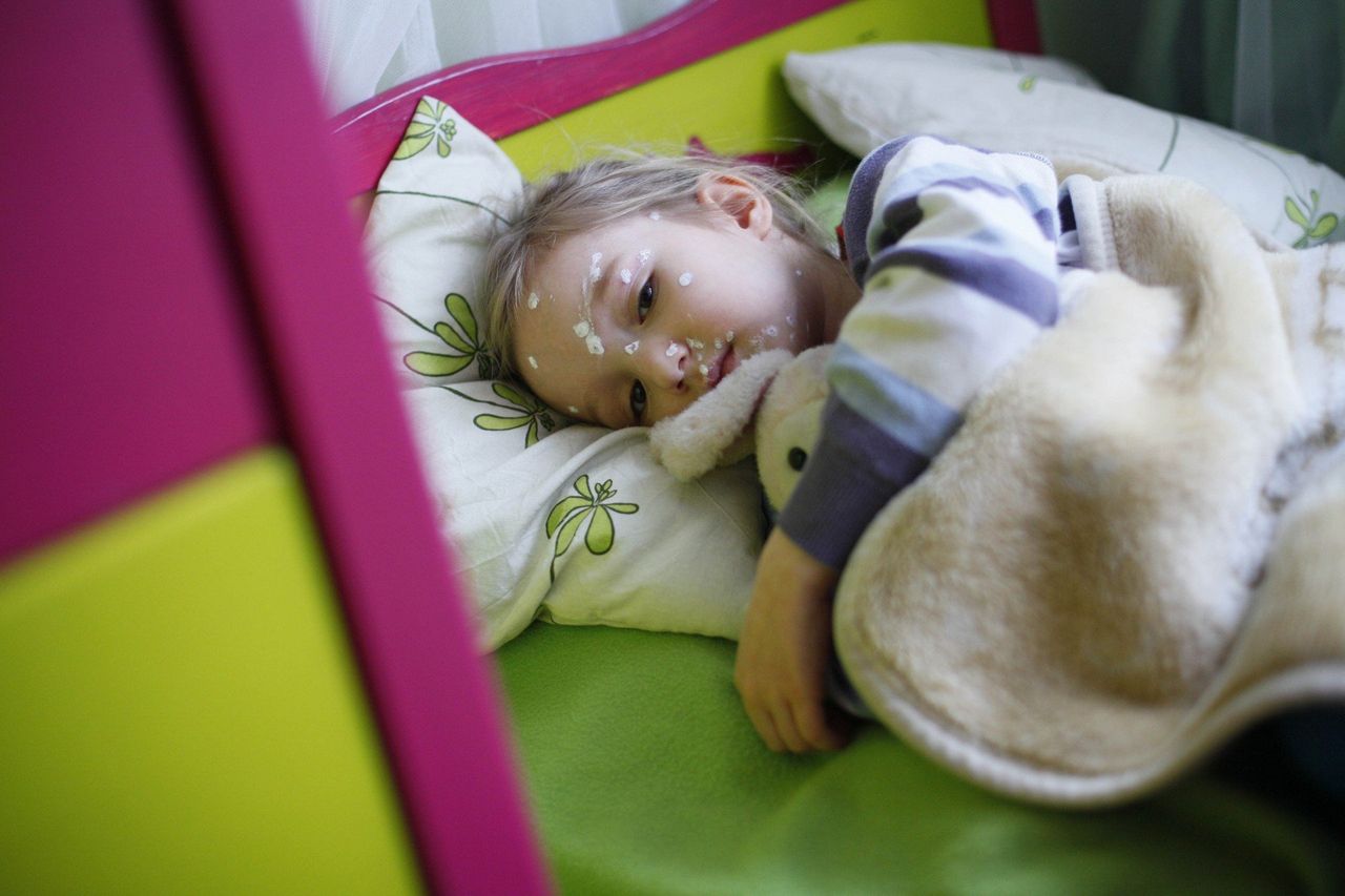 Kalisz: Sanepid alarmuje. Ponad 1600 przypadków ospy