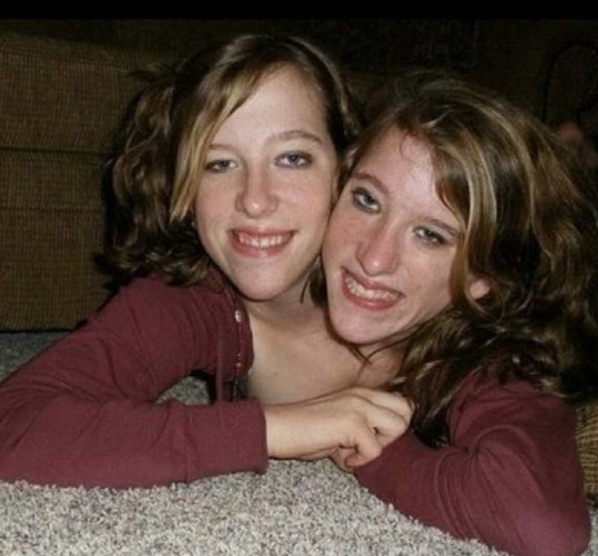 Abby i Brittany Hensel 