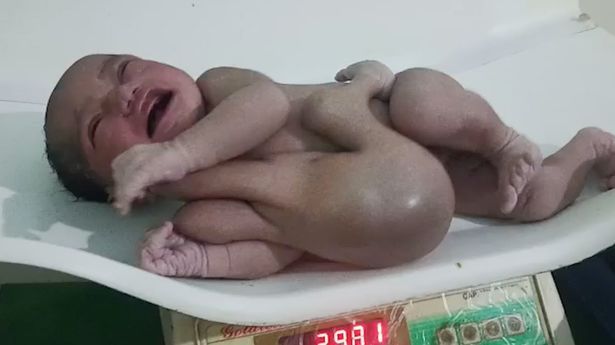 Dziecko miało dodatkowe kończyny