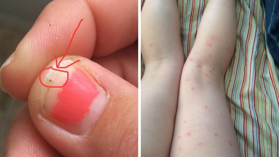 Kleszcze w ciele Emmalee