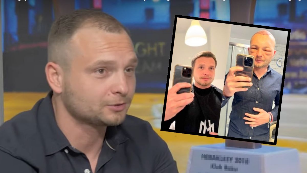 Influencer pokazał spuchniętą twarz po przeszczepie włosów