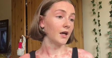 Mówi, że ma skórę w panterkę. Niełatwo przyszło jej zaakceptowanie choroby