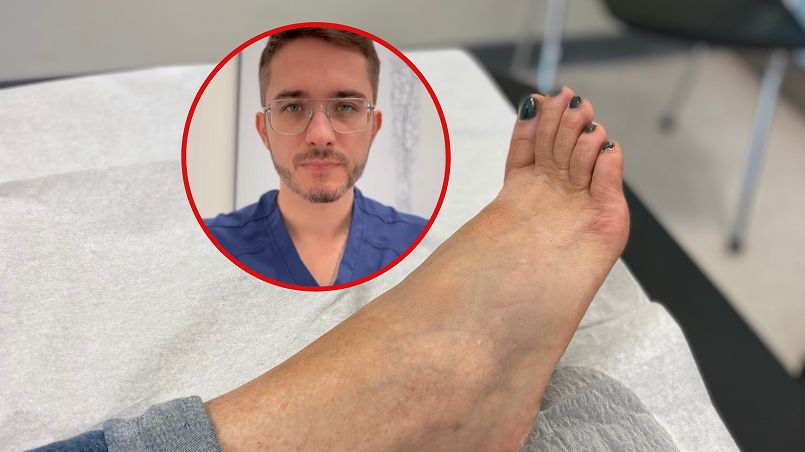 "Korona żylna" to objaw związany z chorobami naczyniowymi