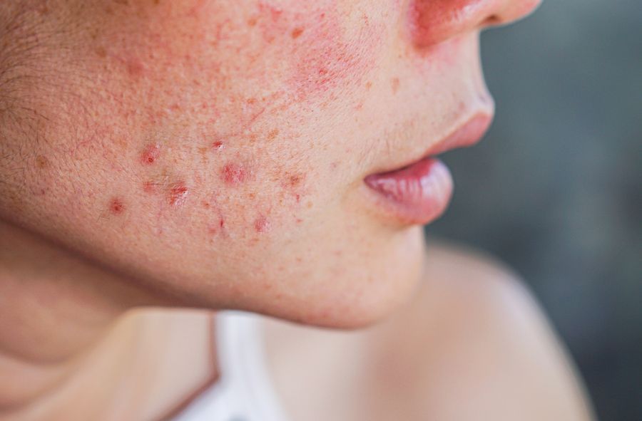 How to eliminate post-acne scars with a revolutionary treatment