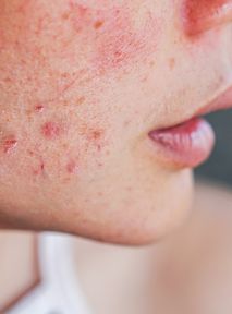 How to eliminate post-acne scars with a revolutionary treatment