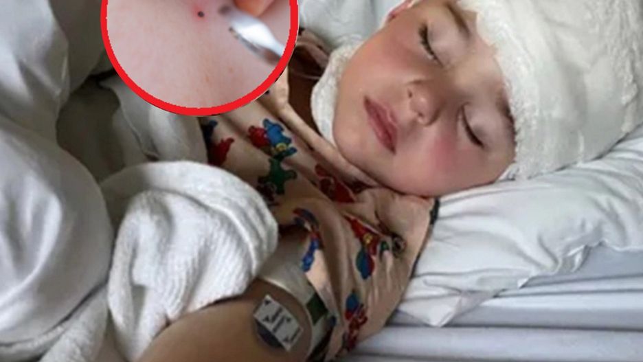 Zauważyła "czarną kropkę" na ciele 3-latka. Jego stan zaczął się pogarszać