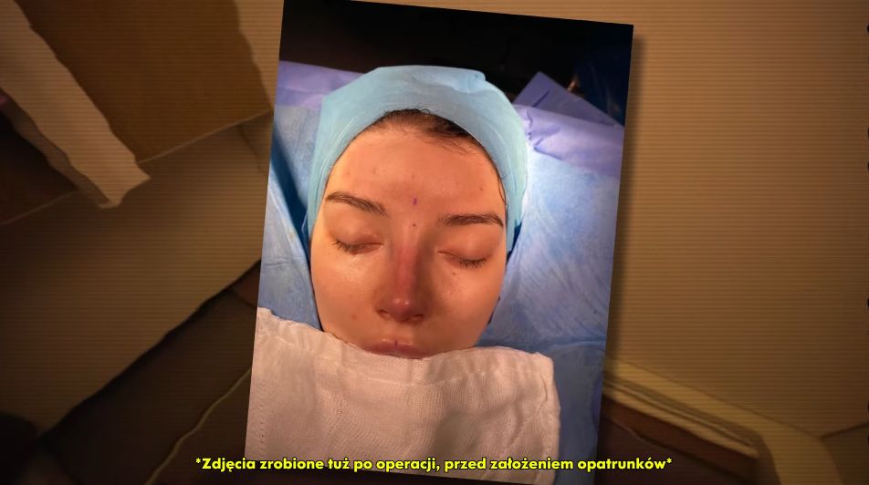 Marcysia Ryskala zrobiła operację nosa