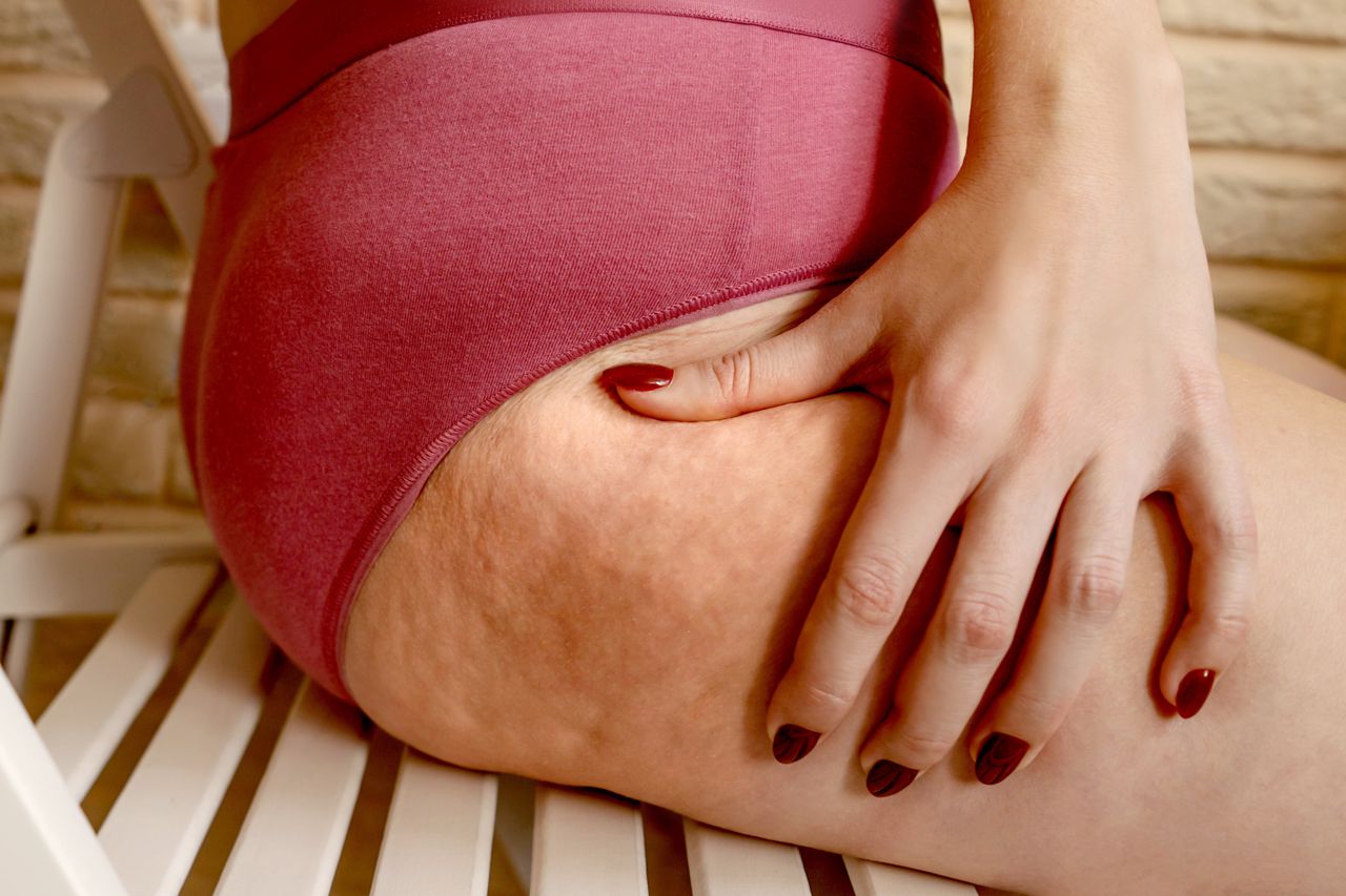 Close-up cellulite on leg.Woman holding fold of skin, cellulite on female body, beige background. Red manicure. Close-up part pf body.cellulite, body, leg, foot, booty, female, skin, woman, background, holding, fold, weight, diet, healthy, overweight, waist, care, fat, figure, health, hand, loss, girl, nutrition, shape, liposuction, unhealthy, lifestyle, person, dieting, lose, slimming, obesity, waistline, closeup, adult, people, fatty, fit, calories, beautiful, obese, surgery, part, close-up, chair