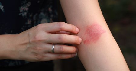 Masz atopową skórę? Ekspertka wskazuje, jak złagodzić problem
